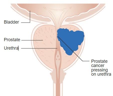 Doctor Explains How Prostate Cancer Screening And Treatment Have Evolved To Reduce Unnecessary Biopsies