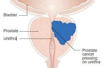 Doctor Explains How Prostate Cancer Screening And Treatment Have Evolved To Reduce Unnecessary Biopsies