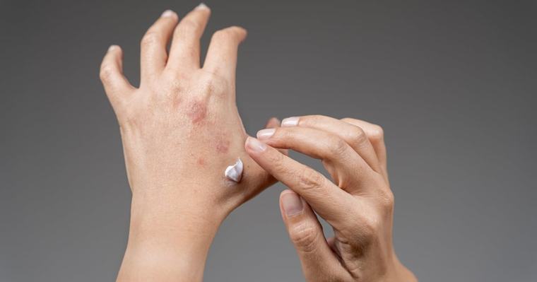 What delgocitinib reveals about Australia's Pharmaceutical Benefits Scheme